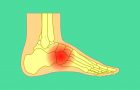 artritis