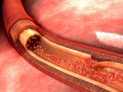 pucanje aorte