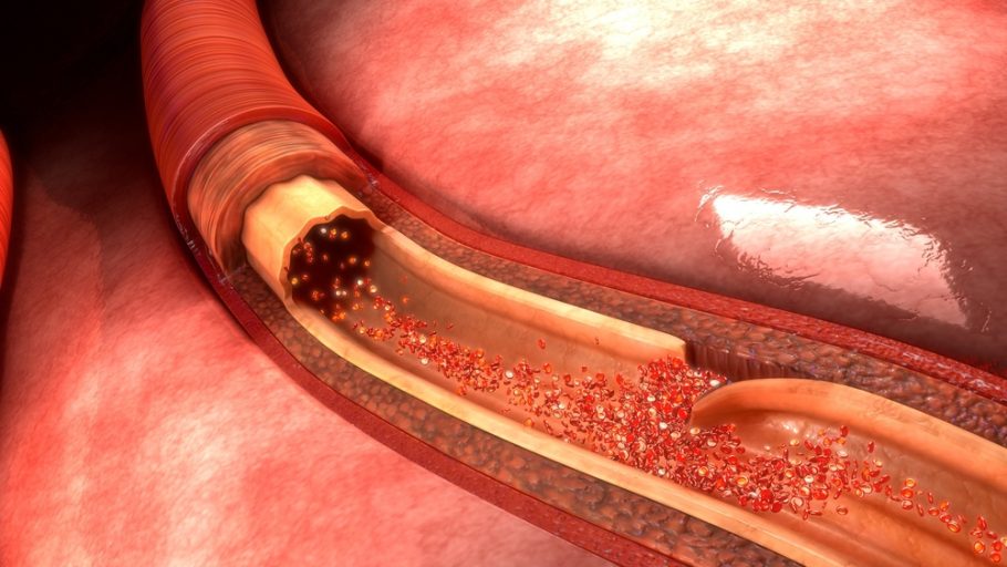 pucanje aorte