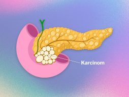 karcinom pankreasa