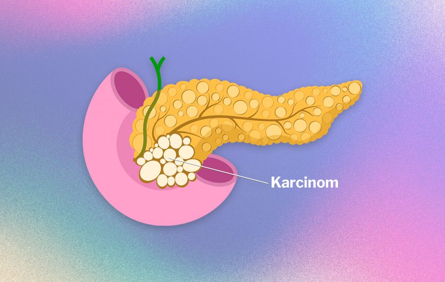 karcinom pankreasa