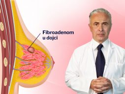 Fibroadenom dr Miloš Počekovac