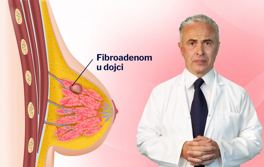 Fibroadenom dr Miloš Počekovac