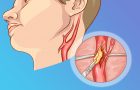 Bolest karotidne arterije