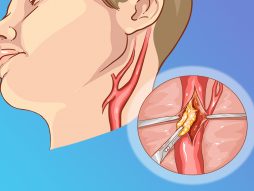 Bolest karotidne arterije