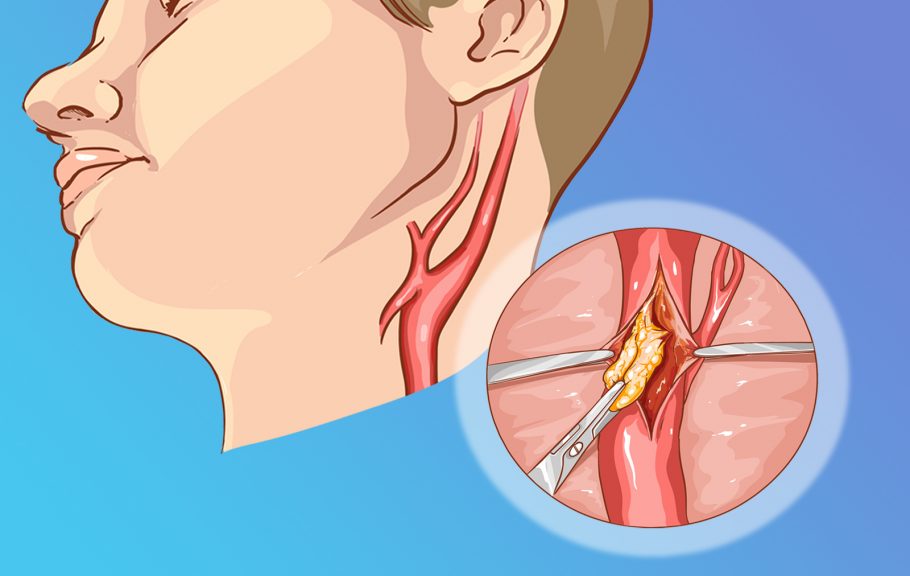 Bolest karotidne arterije