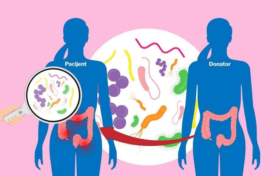 fekalna transplatacija