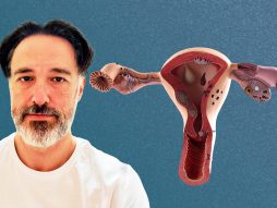 Endometrioza dr Goran Gavrilović