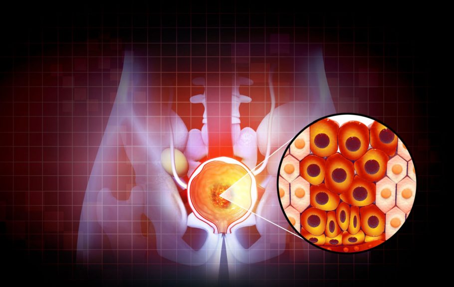 rak prostate