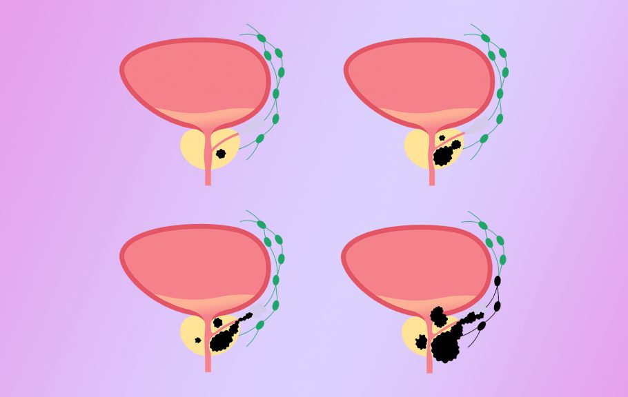 metastatski rak prostate