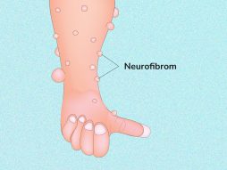 Neurofibrom