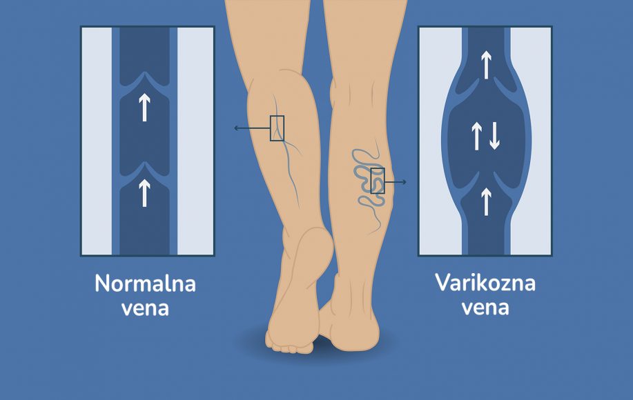 površinska upala vena